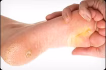 Xử lý vết chai chân