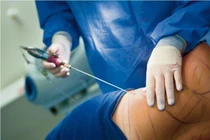 Tử vong vì sốc nhiễm trùng sau hút mỡ bụng