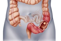 Tưởng đau nhức thông thường hóa ung thư 