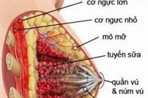 Rửa ống tuyến vú phát hiện sớm ung thư