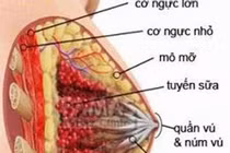 Rửa ống tuyến vú phát hiện sớm ung thư
