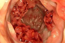 Xét nghiệm chẩn đoán sớm ung thư trực tràng