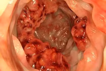 Xét nghiệm chẩn đoán sớm ung thư trực tràng