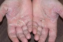 Mắc bệnh tổ đỉa vì tiếp xúc bùn đất