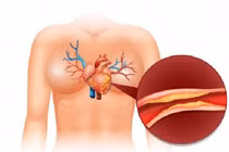 Máu nhiễm mỡ – yếu tố nguy cơ cao gây xơ vữa động mạch