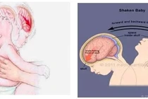 Trẻ xuất huyết não vì sự rung lắc dỗ dành