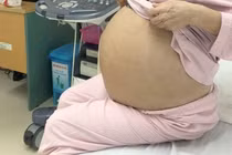 “Mang bầu” khối u 5,5 kg ở tuổi 71