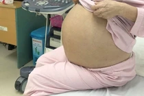 “Mang bầu” khối u 5,5 kg ở tuổi 71