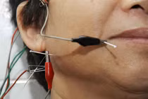 Điện châm điều trị stress