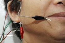 Điện châm điều trị stress
