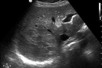 U gan do ký sinh trùng