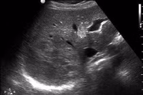 U gan do ký sinh trùng