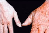 Bệnh nhân to đầu chi có tăng nguy cơ bị ung thư?