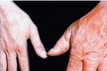 Bệnh nhân to đầu chi có tăng nguy cơ bị ung thư?