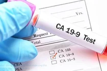  Chỉ số CA 19-9 sau mổ ung thư tụy 