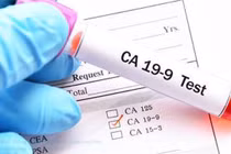  Chỉ số CA 19-9 sau mổ ung thư tụy 