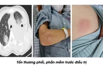 Cứu sống một phụ nữ Tuyên Quang bị vi khuẩn ăn thịt người (Whitmore) tấn công