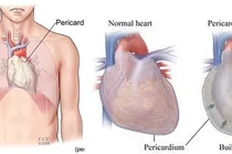 Ung thư và tràn dịch màng ngoài tim ác tính