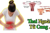 2 phương pháp điều trị thai ngoài tử cung