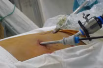 Nhiễm trùng lỗ trocar