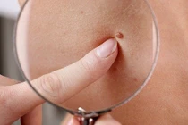 U hắc tố trẻ em 