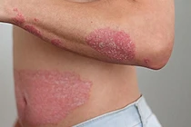 Giải pháp cải thiện bệnh vảy nến an toàn, hiệu quả từ sản phẩm thảo dược