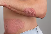 Giải pháp cải thiện bệnh vảy nến an toàn, hiệu quả từ sản phẩm thảo dược