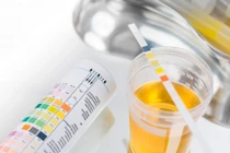 4 nhóm nguyên nhân gây tiểu máu