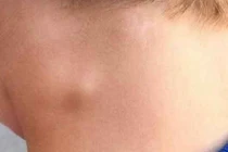 Tưởng mắc ung thư hóa ra lao hạch 