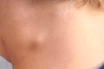 Tưởng mắc ung thư hóa ra lao hạch 