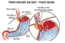 Trào ngược dạ dày thực quản có thể dẫn đến ung thư