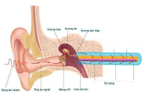 Điếc do tắc vòi nhĩ