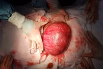 U xơ cơ tử cung kích thước lớn ở bệnh nhân trẻ sử dụng testosterone dài ngày