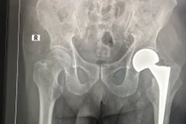 Thay khớp háng cho bệnh nhân 98 tuổi