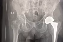 Thay khớp háng cho bệnh nhân 98 tuổi