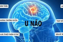 Tưởng hoa mắt vì đói nào ngờ u não