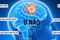 Tưởng hoa mắt vì đói nào ngờ u não