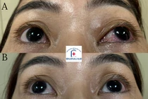 Nút mạch điều trị thông động mạch cảnh xoang hang hiếm gặp