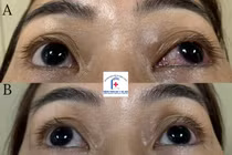 Nút mạch điều trị thông động mạch cảnh xoang hang hiếm gặp