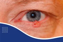 Nhận biết u lành tính và ác tính ở mắt