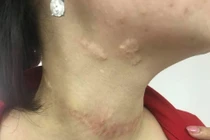 Sẹo chằng chịt vì chữa bướu cổ bằng đắp lá