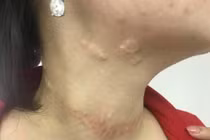 Sẹo chằng chịt vì chữa bướu cổ bằng đắp lá