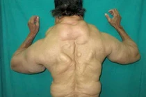 Thích uống rượu sinh bệnh u mỡ 