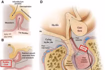 Bất ngờ đái nhiều, thay đổi tính cách phát hiện u sọ hầu