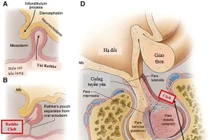 Bất ngờ đái nhiều, thay đổi tính cách phát hiện u sọ hầu