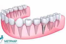 Cấy răng giả vào chỗ răng hỏng