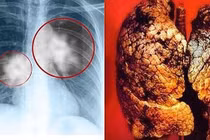 Ung thư phổi di căn