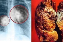 Ung thư phổi di căn