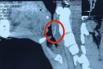 Uống vitamin C cho xương cá tan, bệnh nhân bị nhiễm trùng vùng cổ nặng