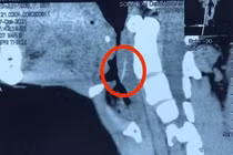 Uống vitamin C cho xương cá tan, bệnh nhân bị nhiễm trùng vùng cổ nặng